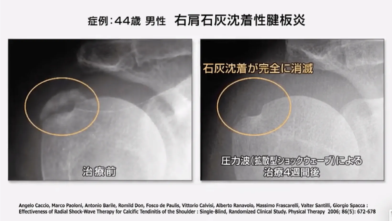 症例:44歳 男性 右肩石灰沈着性腱板炎